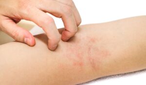 Exposición al calor y contaminación del aire incrementan dermatitis atópicas