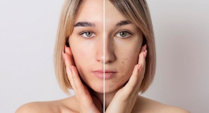 El acné deja secuelas físicas y psicológicas