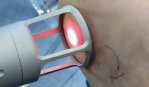 Láser de Alta Intensidad acaba de inmediato con el dolor de la artrosis de rodilla