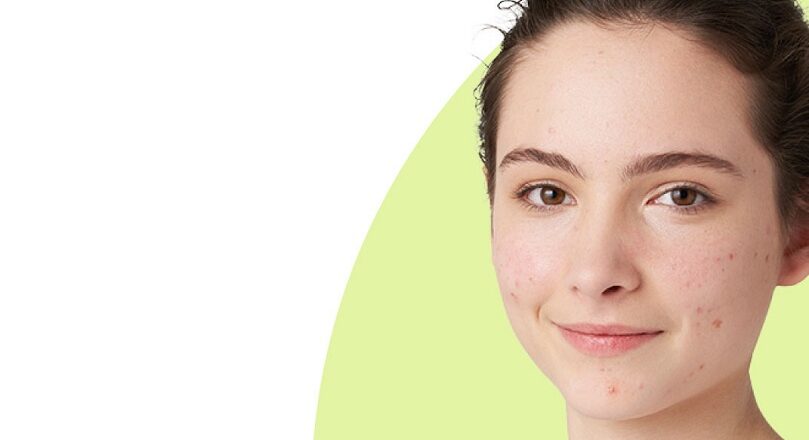 4 recomendaciones para combatir el acné de forma holística