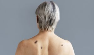 Clínica Piedra Azul realizará jornada gratuita de despistaje de melanoma