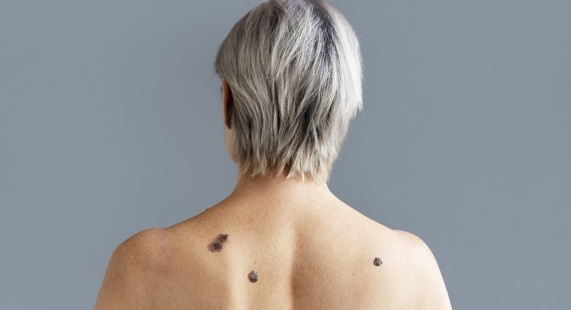 Clínica Piedra Azul realizará jornada gratuita de despistaje de melanoma